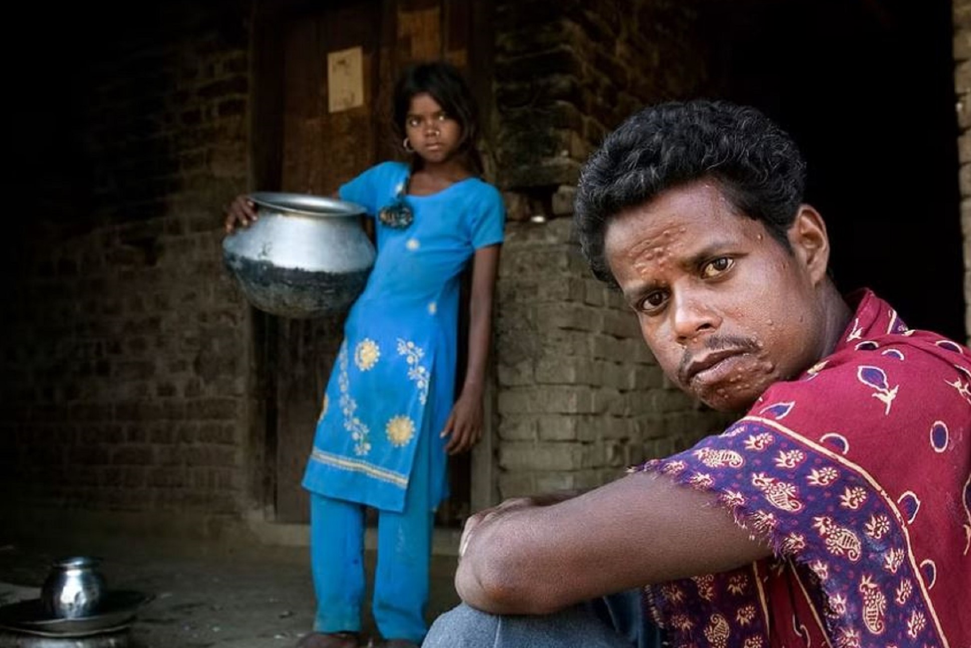 PKDL Patients in Bangladesh-ok PKDL Patients in Bangladesh
